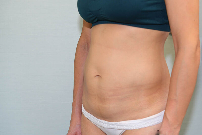 Abdominoplasty Before & After Patient Photo