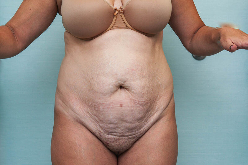 Abdominoplasty Before & After Patient Photo