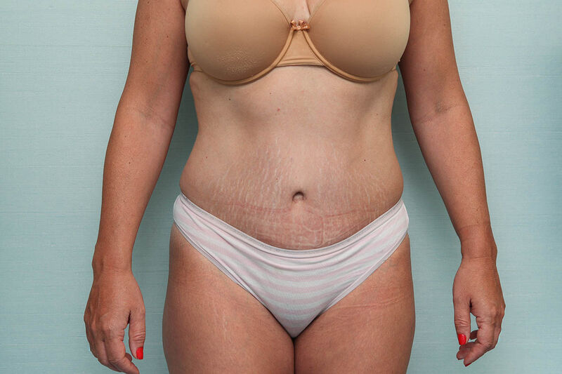 Abdominoplasty Before & After Patient Photo