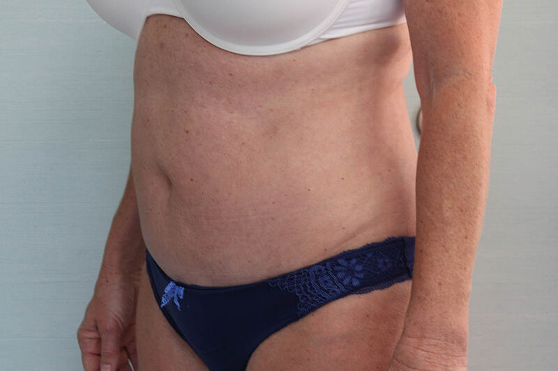 Abdominoplasty Before & After Patient Photo
