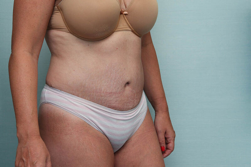 Abdominoplasty Before & After Patient Photo