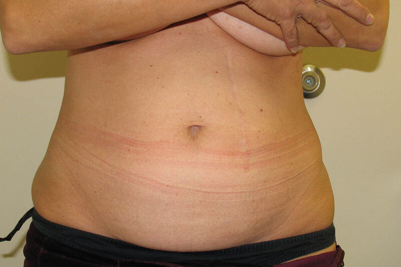 Abdominoplasty Before & After Patient Photo