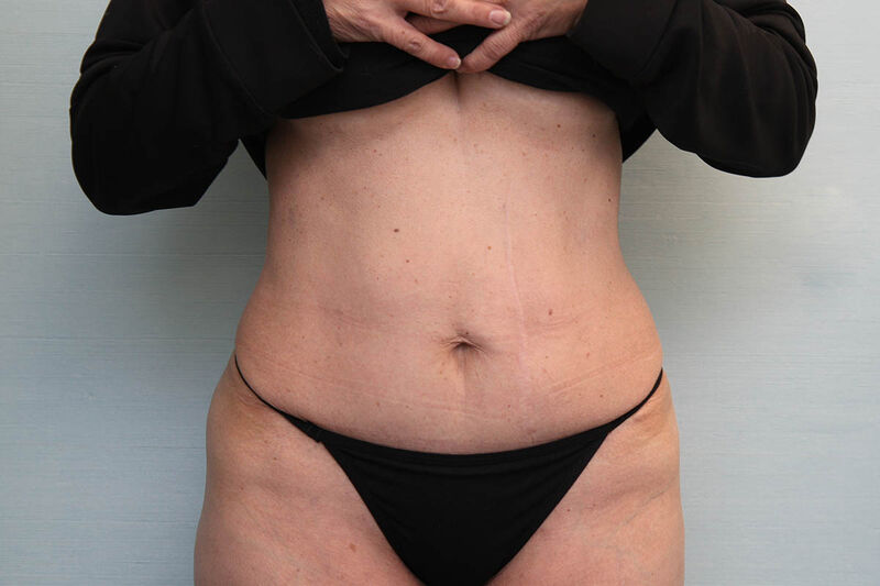 Abdominoplasty Before & After Patient Photo