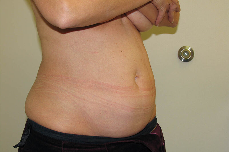 Abdominoplasty Before & After Patient Photo