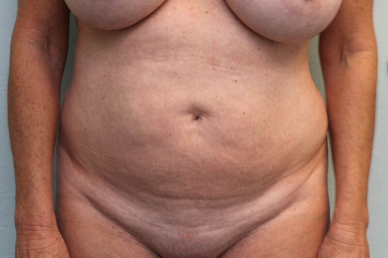 Abdominoplasty Before & After Patient Photo