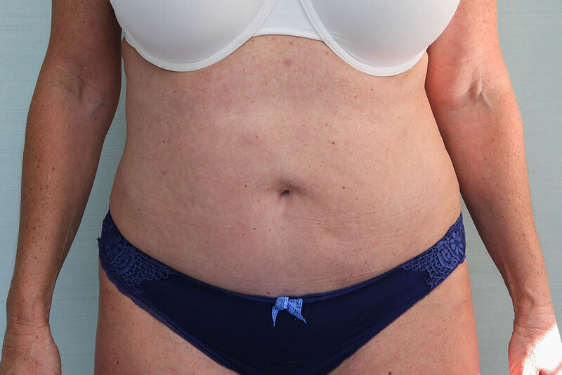 Abdominoplasty Before & After Patient Photo