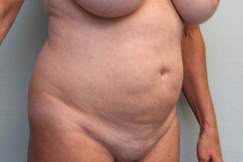 Abdominoplasty Before & After Patient Photo