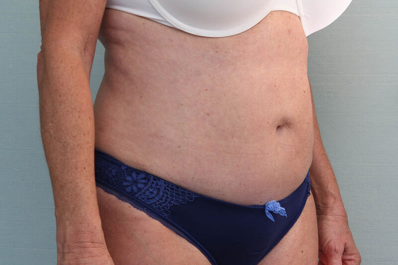 Abdominoplasty Before & After Patient Photo