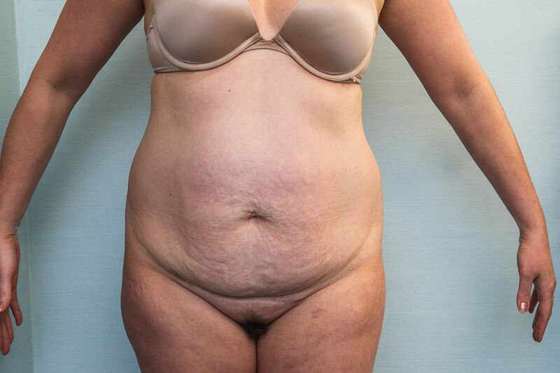 Abdominoplasty Before & After Patient Photo