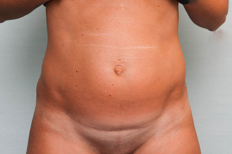 Abdominoplasty Before & After Patient Photo