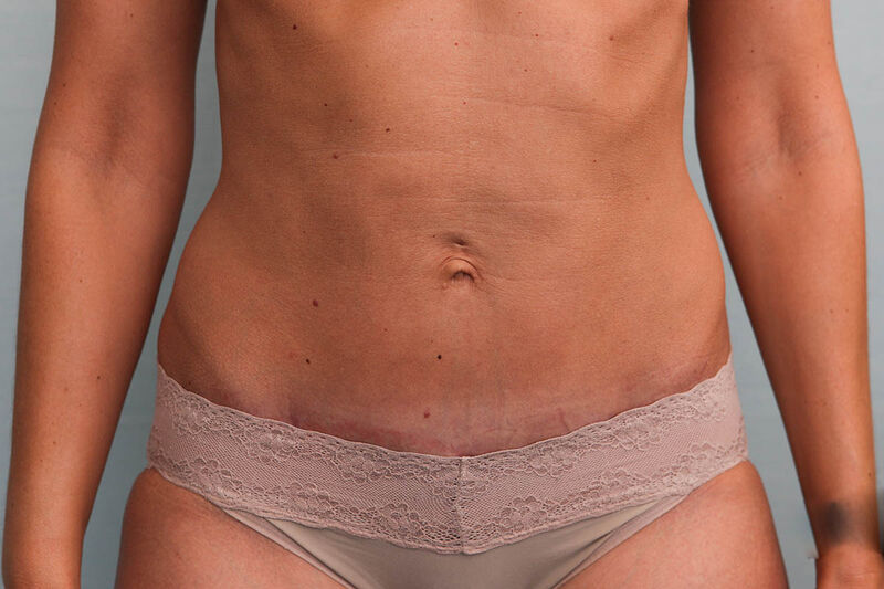 Abdominoplasty Before & After Patient Photo