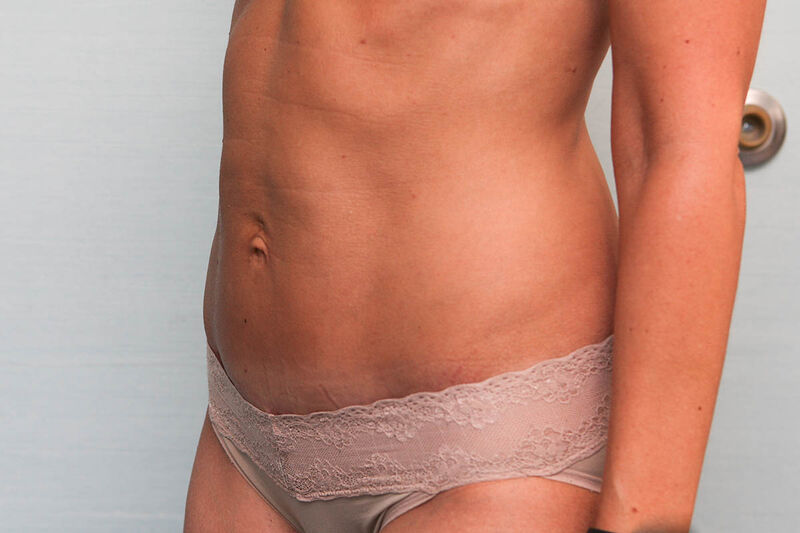 Abdominoplasty Before & After Patient Photo