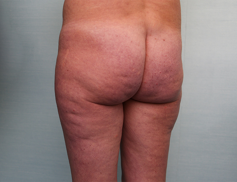 BodyTite Before & After Patient Photo