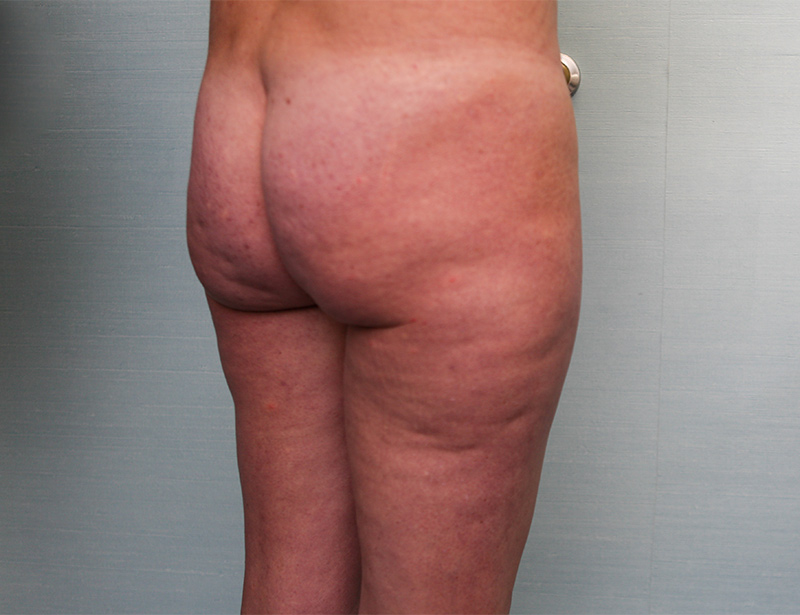 BodyTite Before & After Patient Photo