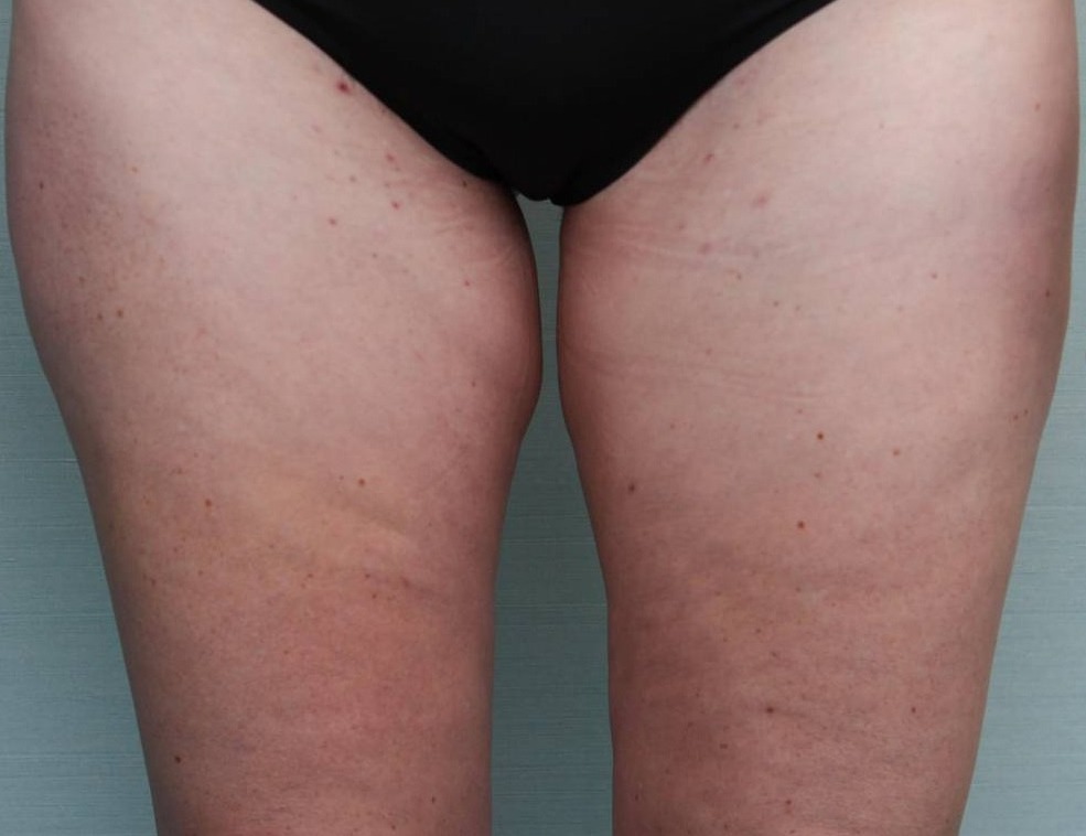 BodyTite Before & After Patient Photo