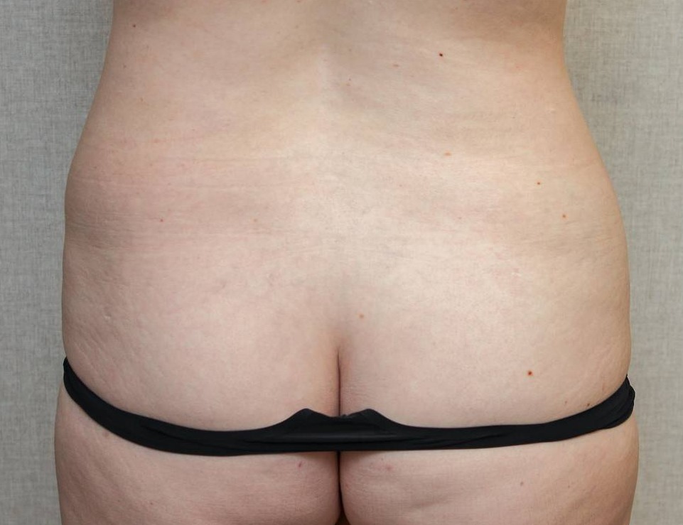 BodyTite Before & After Patient Photo