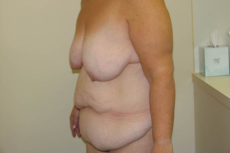 Body Contouring after Weight Loss (MWL) Before & After Patient Photo