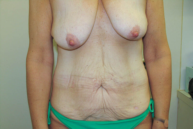 Body Contouring after Weight Loss (MWL) Before & After Patient Photo