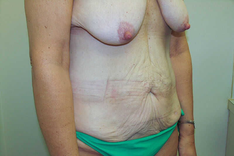 Body Contouring after Weight Loss (MWL) Before & After Patient Photo