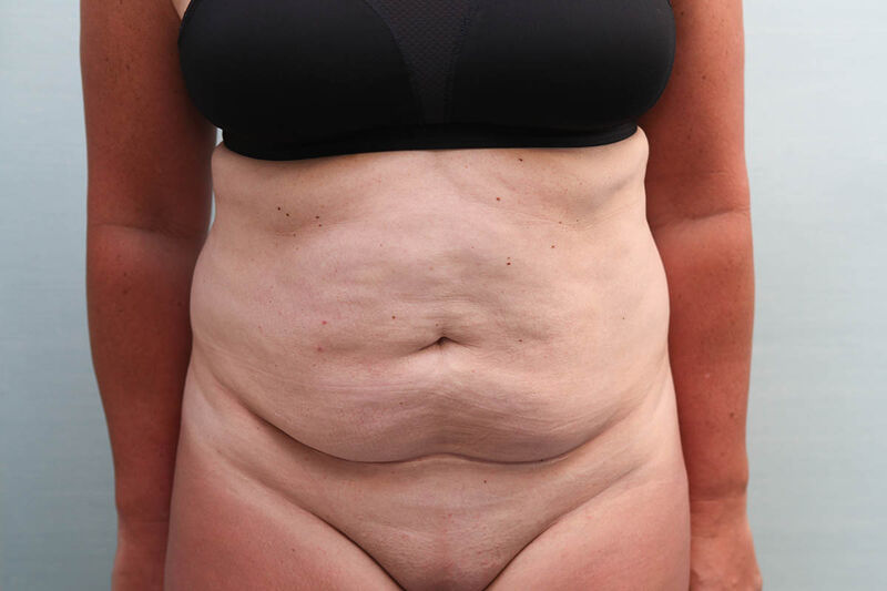 CoolSculpting Before & After Patient Photo