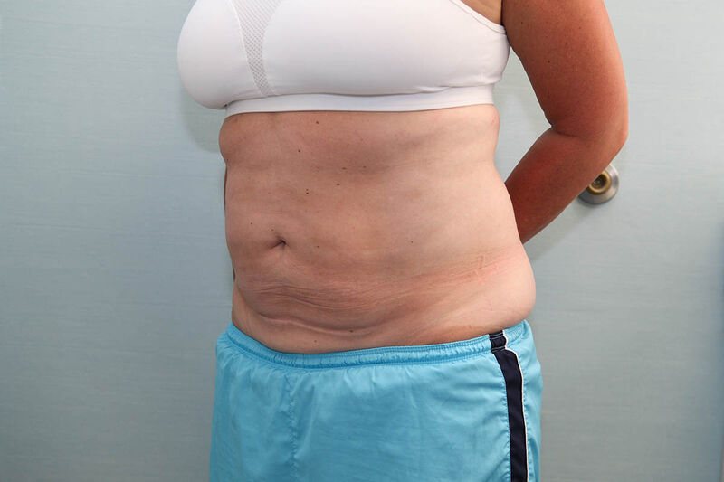 CoolSculpting Before & After Patient Photo