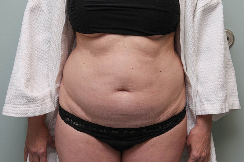 CoolSculpting Before & After Patient Photo