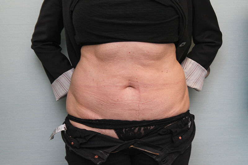 CoolSculpting Before & After Patient Photo