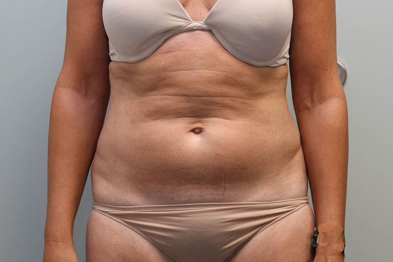 CoolSculpting Before & After Patient Photo