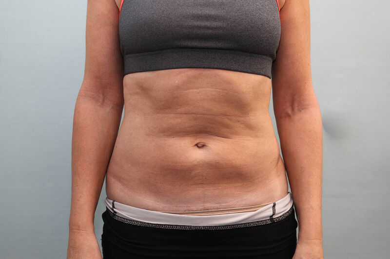 CoolSculpting Before & After Patient Photo