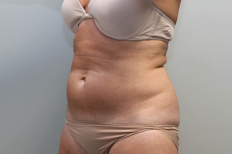 CoolSculpting Before & After Patient Photo