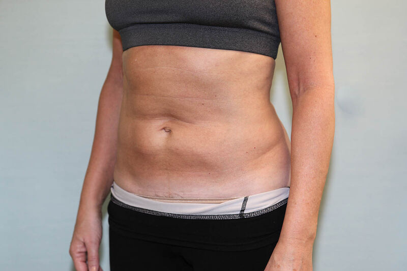 CoolSculpting Before & After Patient Photo