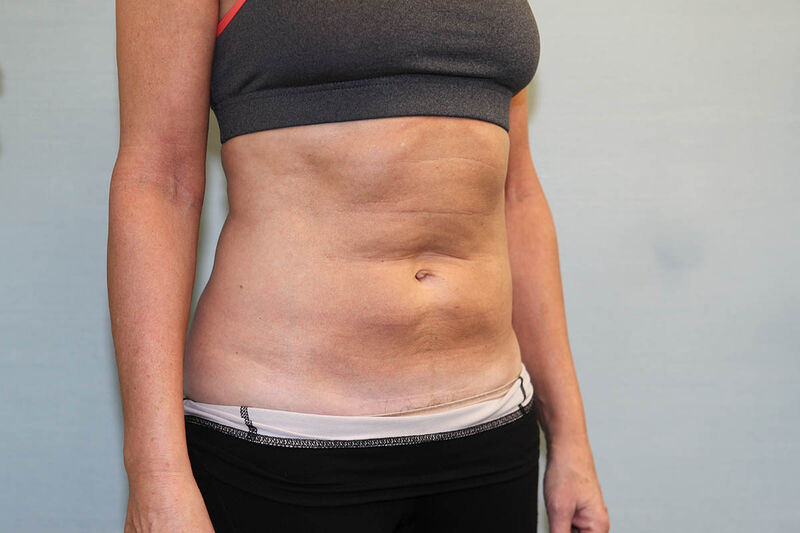 CoolSculpting Before & After Patient Photo