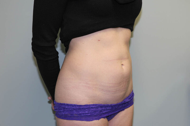 CoolSculpting Before & After Patient Photo