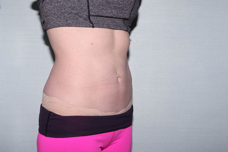 CoolSculpting Before & After Patient Photo