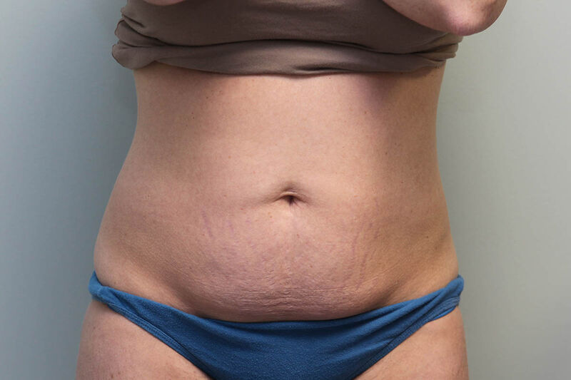 CoolSculpting Before & After Patient Photo