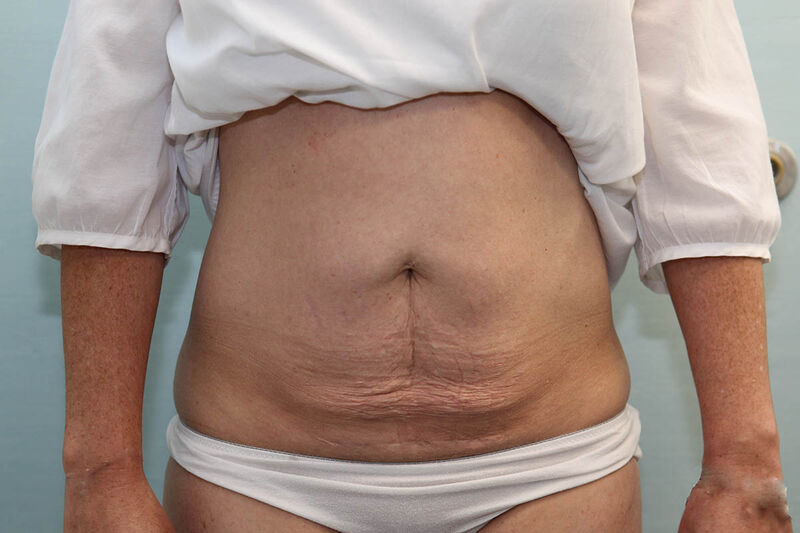 CoolSculpting Before & After Patient Photo