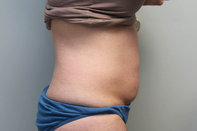 CoolSculpting Before & After Patient Photo