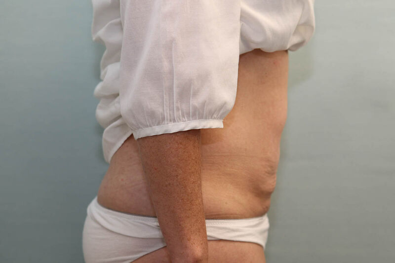 CoolSculpting Before & After Patient Photo