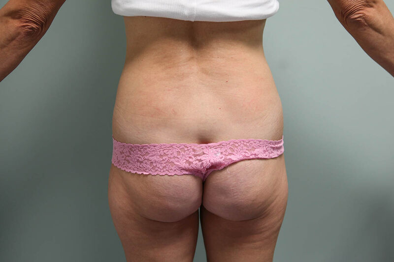 CoolSculpting Before & After Patient Photo