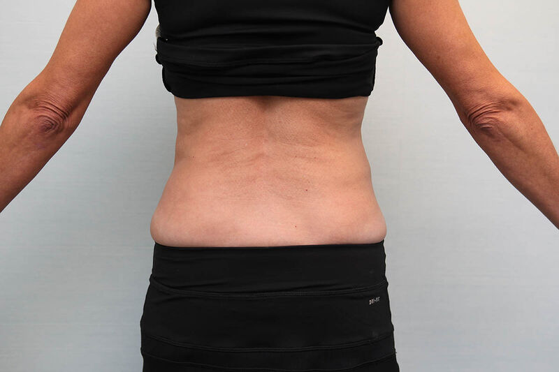 CoolSculpting Before & After Patient Photo