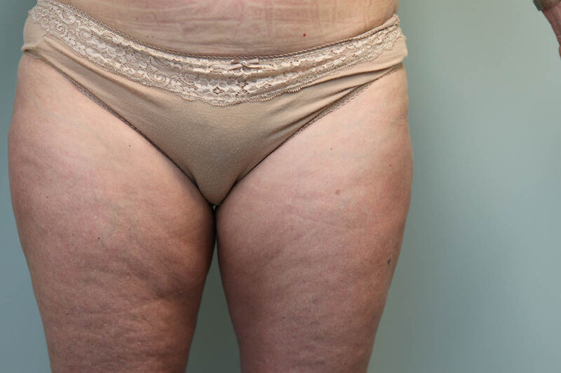 CoolSculpting Before & After Patient Photo