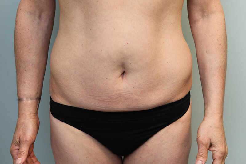 CoolSculpting Before & After Patient Photo