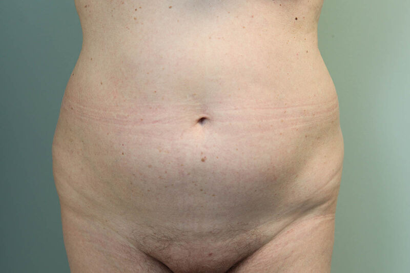 CoolSculpting Before & After Patient Photo