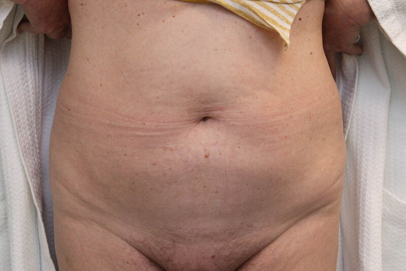 CoolSculpting Before & After Patient Photo