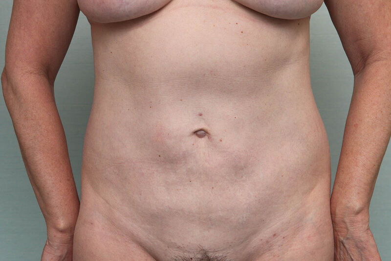 CoolSculpting Before & After Patient Photo