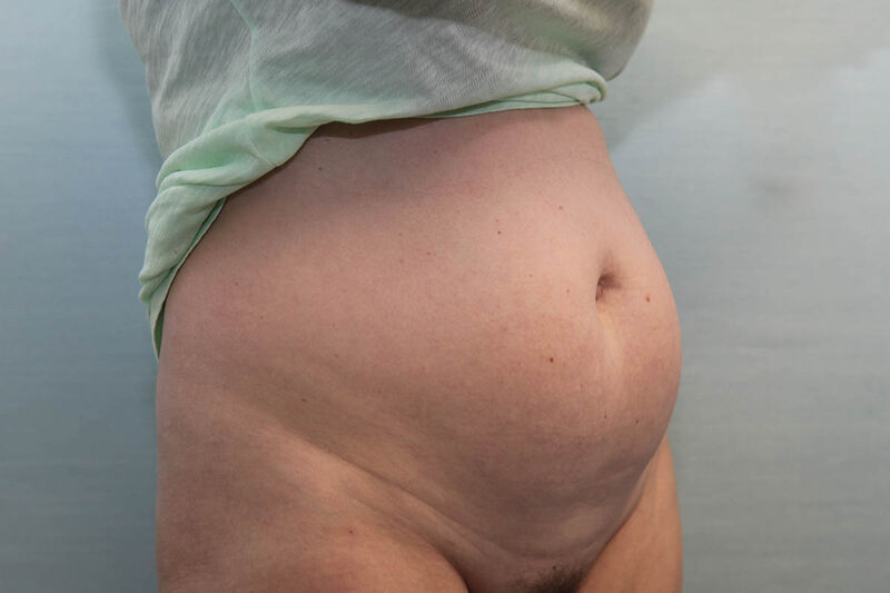 CoolSculpting Before & After Patient Photo