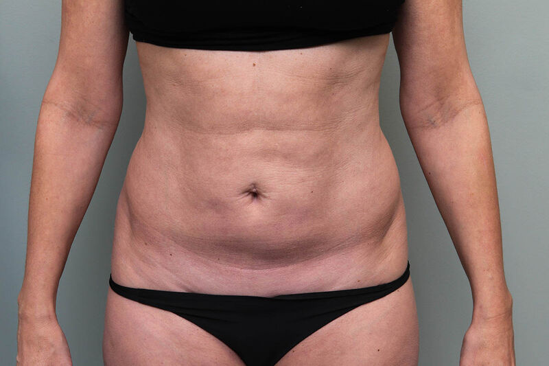 CoolSculpting Before & After Patient Photo