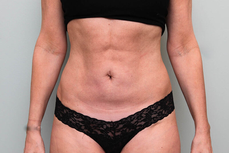 CoolSculpting Before & After Patient Photo