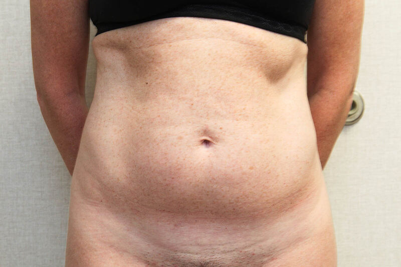 CoolSculpting Before & After Patient Photo