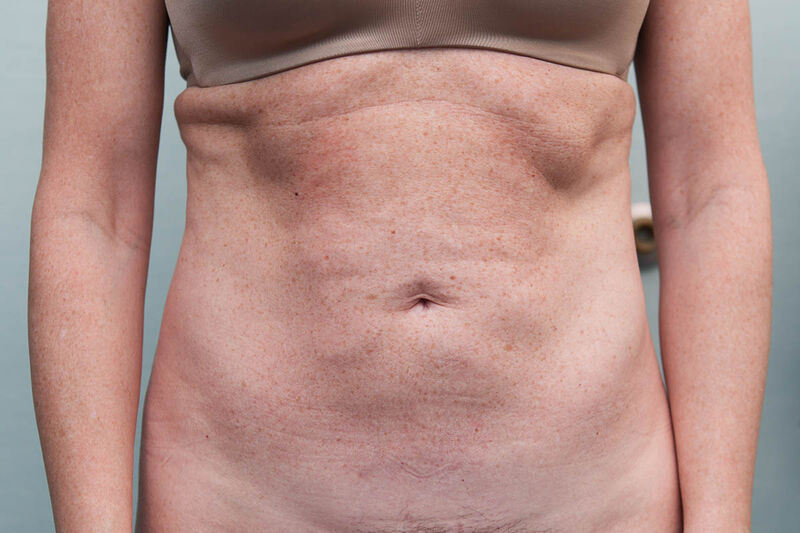 CoolSculpting Before & After Patient Photo